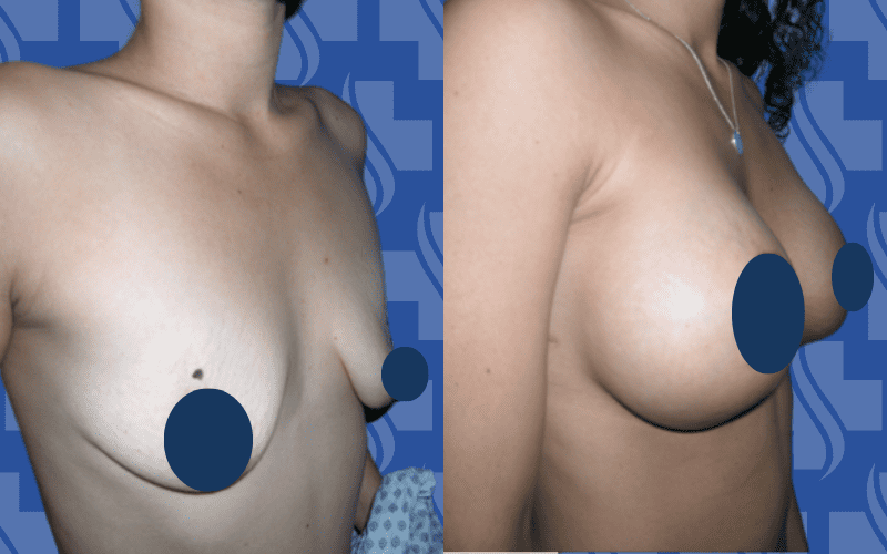 Breast Augmentation