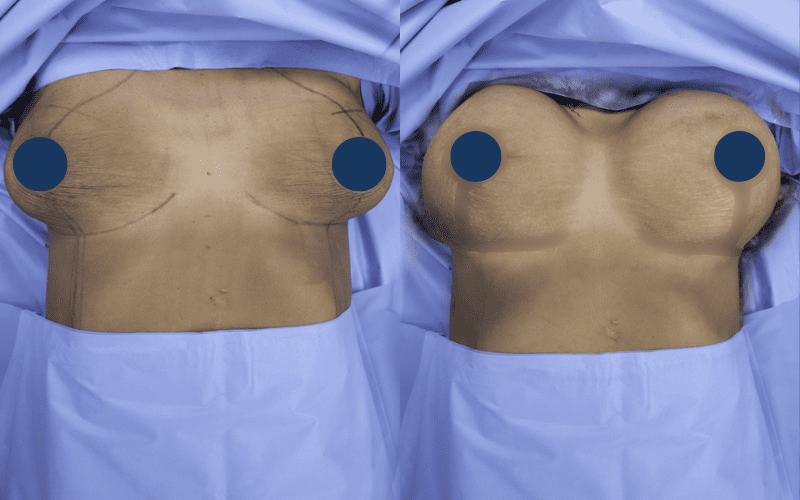 Breast Lift with Implants (2)