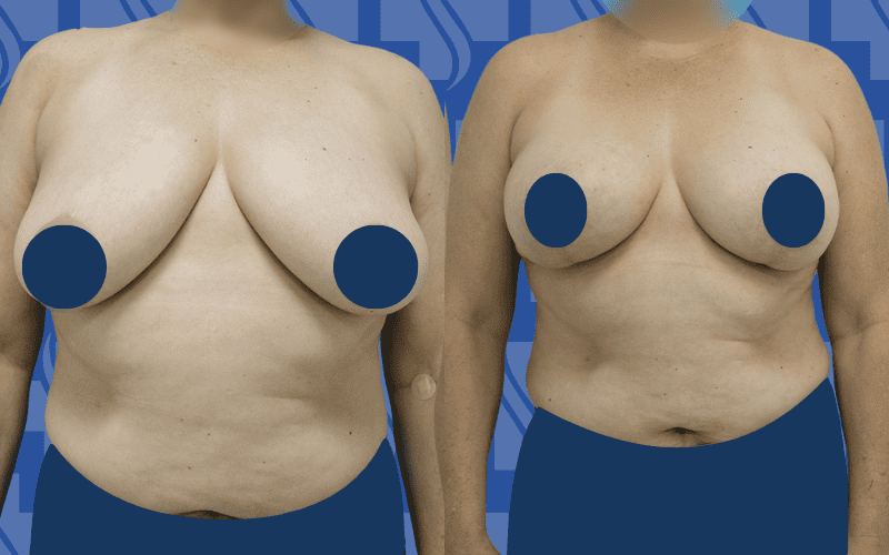 Breast Lift