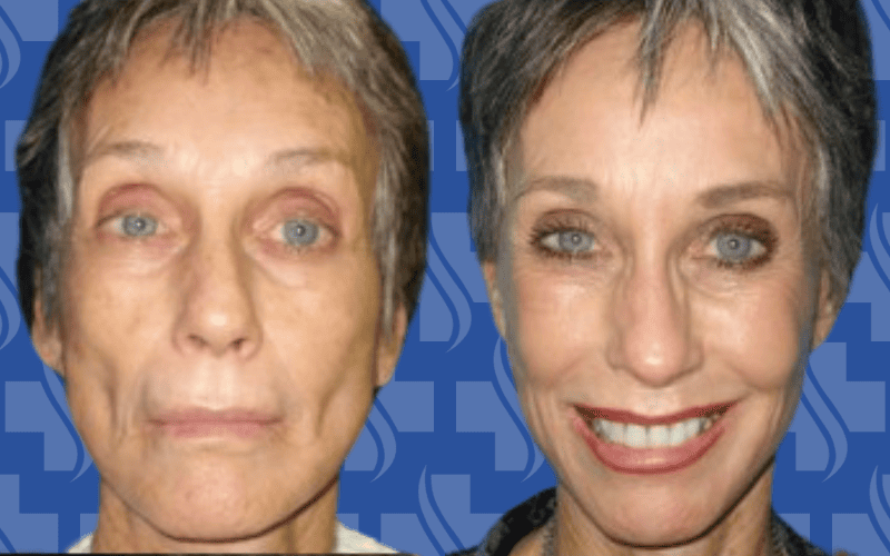 Facelift & Fat Grafting