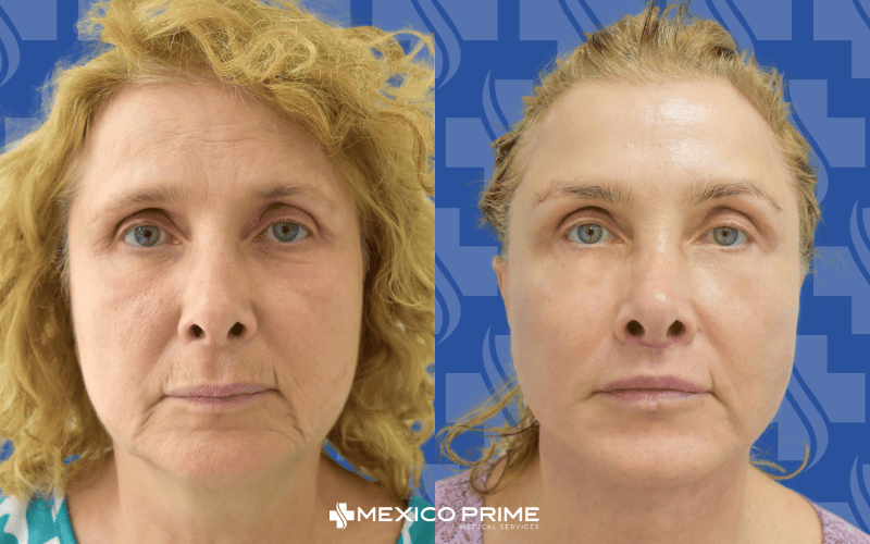 Facelift & Lip Lift