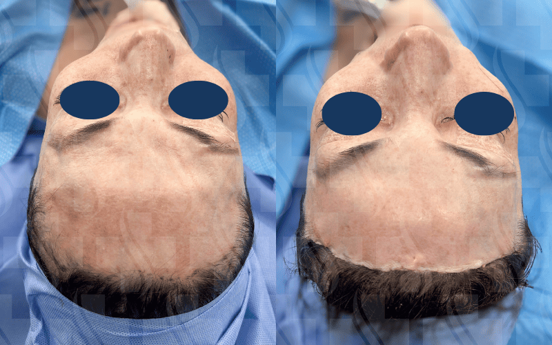 Forehead Reduction