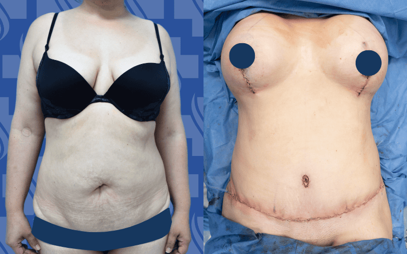 Lipectomy & Breast Implants