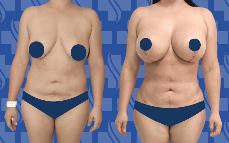 Liposuction & Breast Lift With Implants