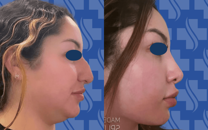 Rhinoplasty, lip filler and double chin lipo