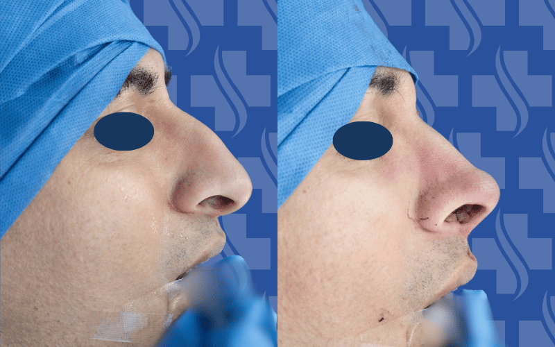 Rhinoplasty
