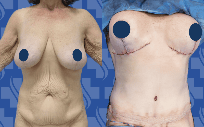 Tummy Tuck & Breast Implants